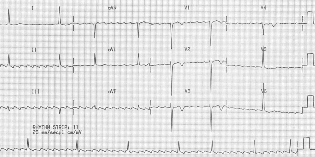 ECG Atrial Flutter with High-Grade AV Block