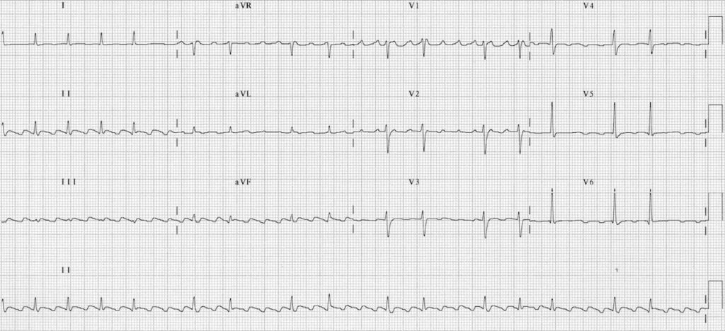 ECG Atrial Flutter with Variable Block