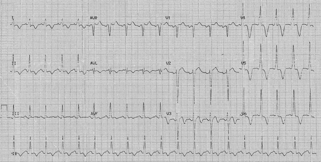 ECG Case 087 LITFL Top 100 EKG