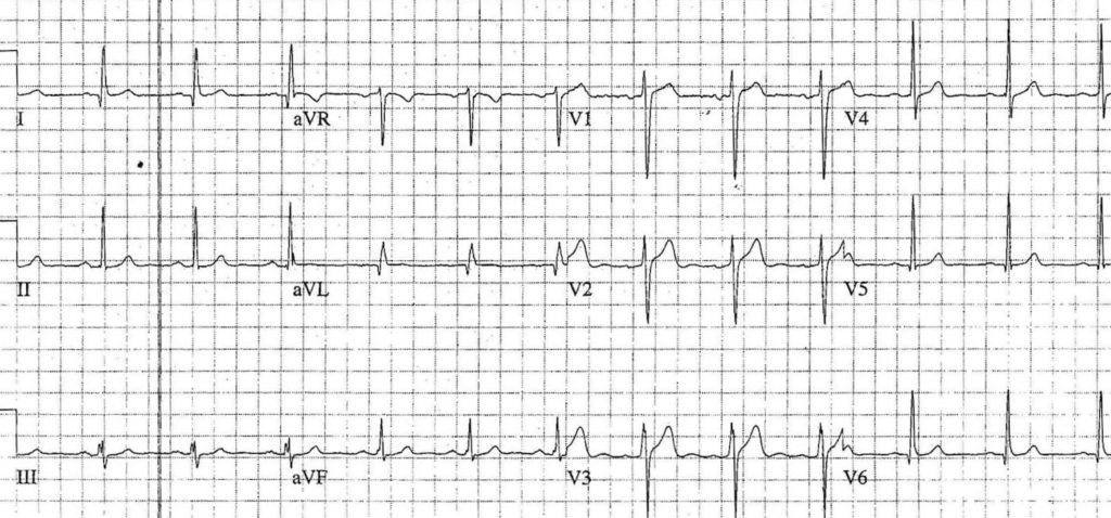 ECG Case 092b LITFL Top 100 EKG