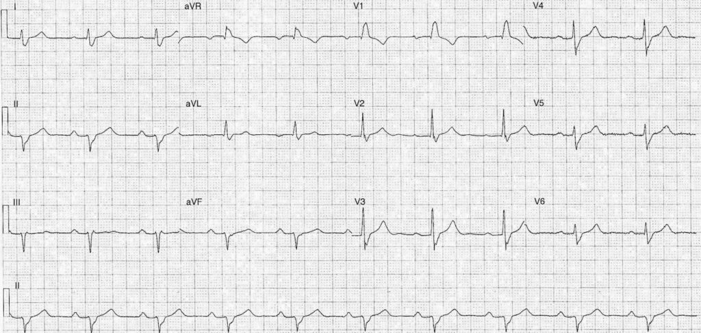 ECG Case 094 LITFL Top 100 EKG