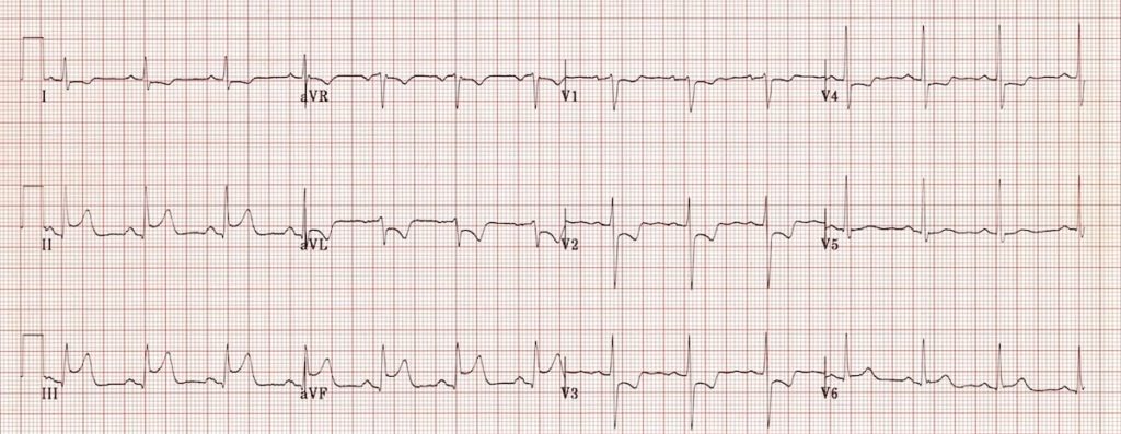 ECG Inferior AMI STEMI 3