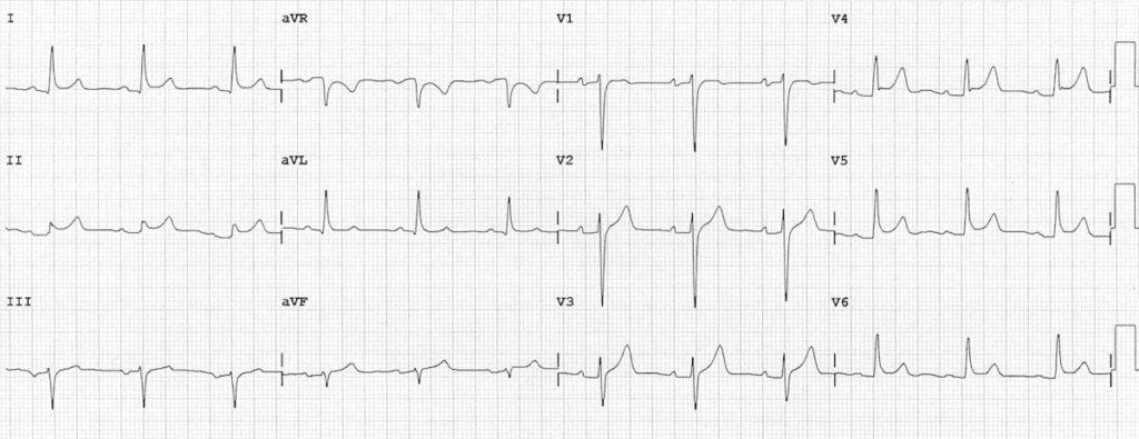 ECG Pericarditis