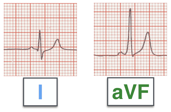 ECG SAM Super Axis Man 001 complexes