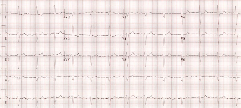 ECG SAM Super Axis Man 003 ECG 2