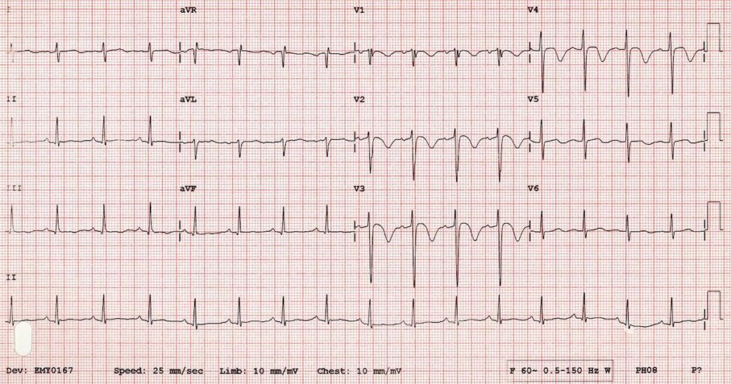 ECG Wellens syndrome potential pseudo