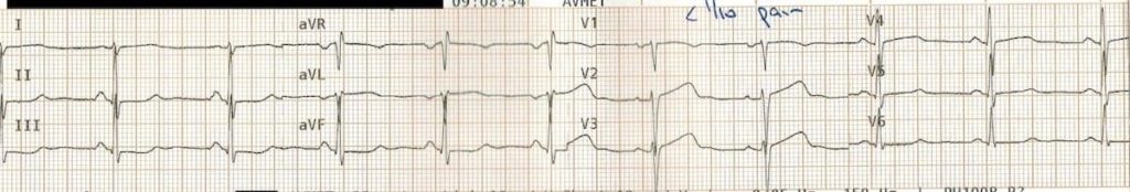 ECG5-T38mins2