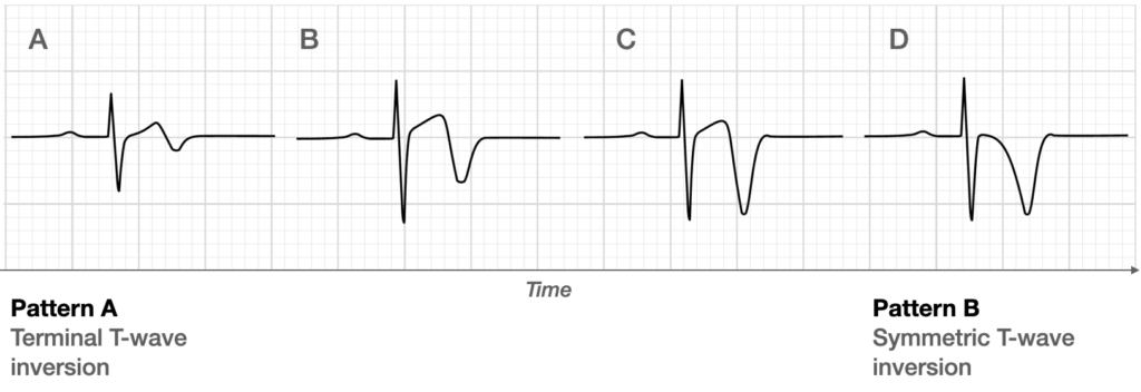 Evolution of T-wave inversion [A-D] after coronary reperfusion in STEMI reperfusion and in Wellens syndrome (NSTEMI)