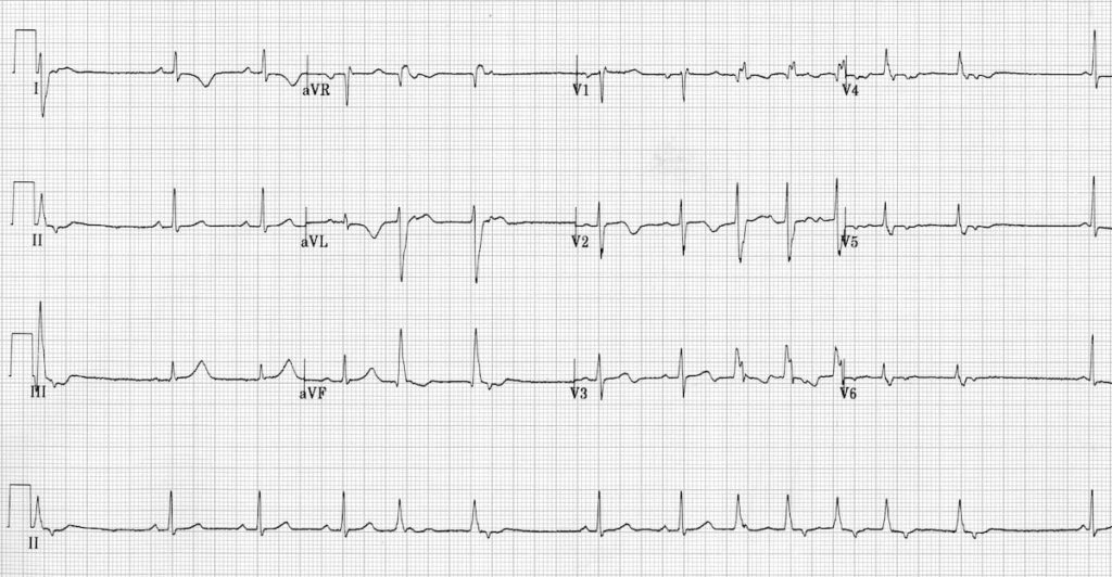 Idiopathic Fascicular Left Ventricular Tachycardia 2a