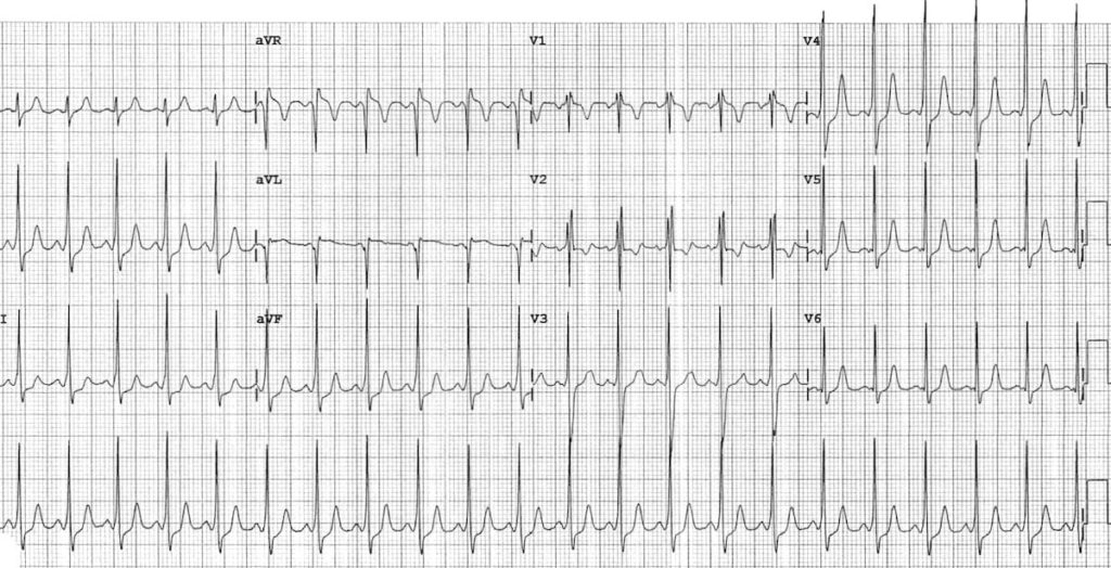 WPW-in-5yo-boy 2