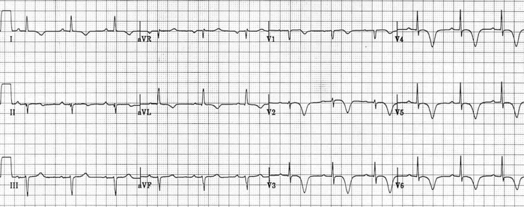 Wellens Syndrome (Type B Pattern)