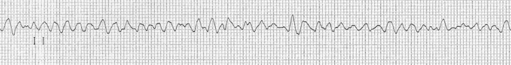 ventricular fibrillation rhythm strip VF
