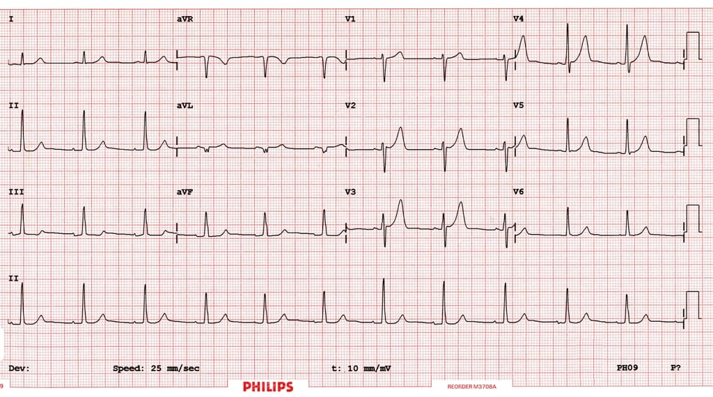 WPW ECG