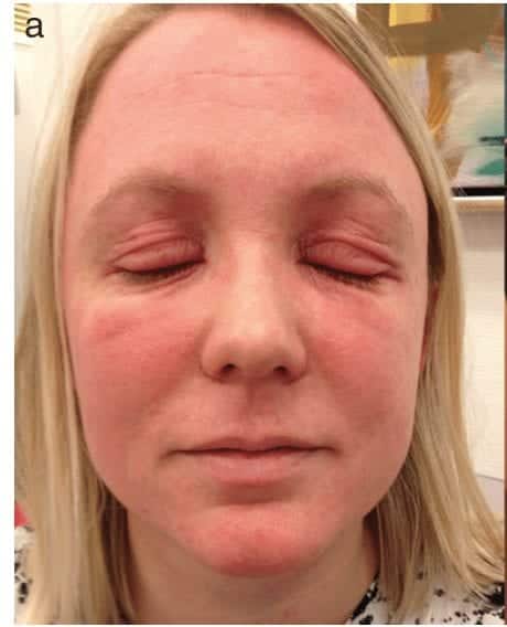 tree dermatitis caused by colophonium allergy 1
