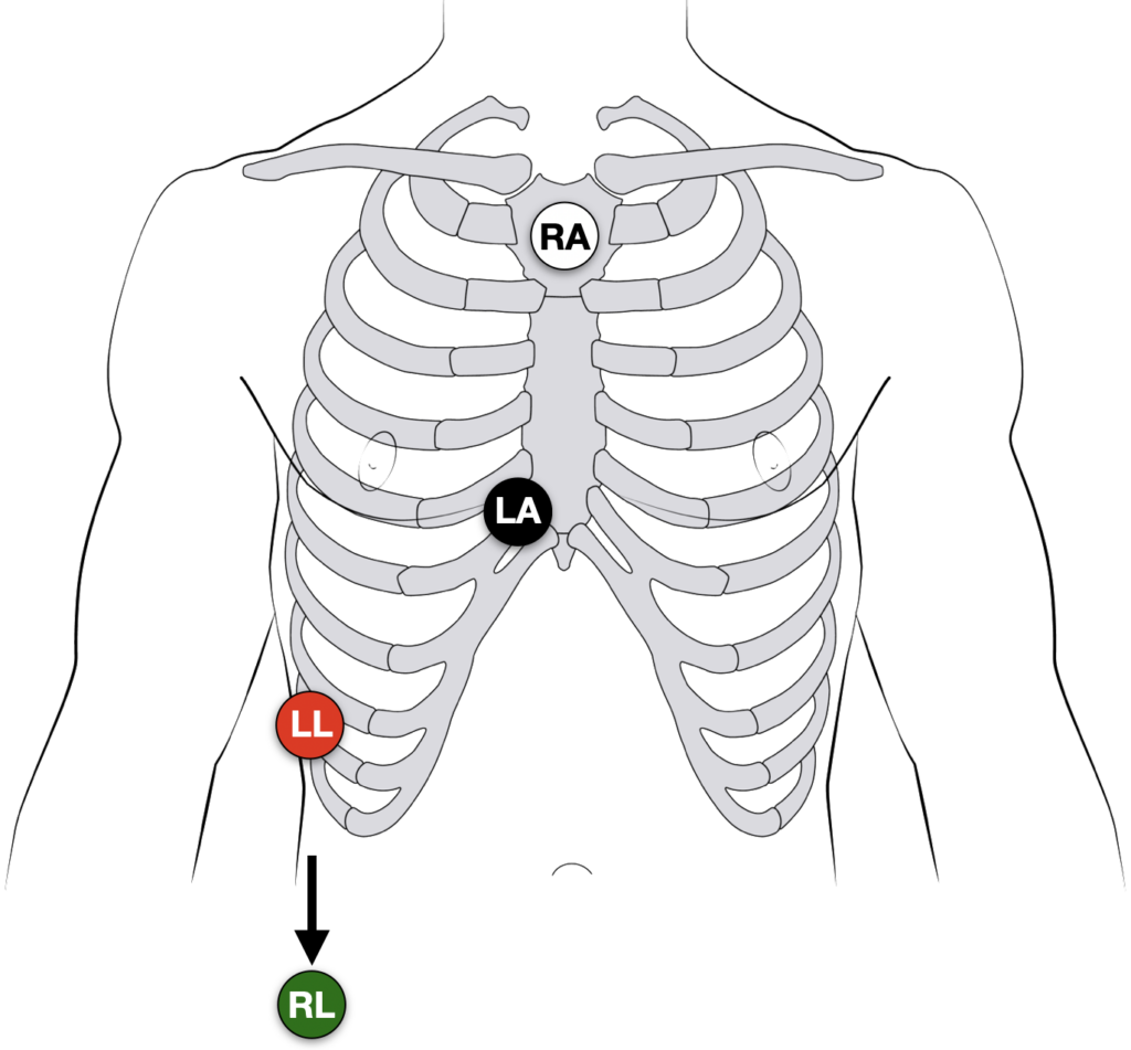 Lewis Lead electrode placement S5 lead