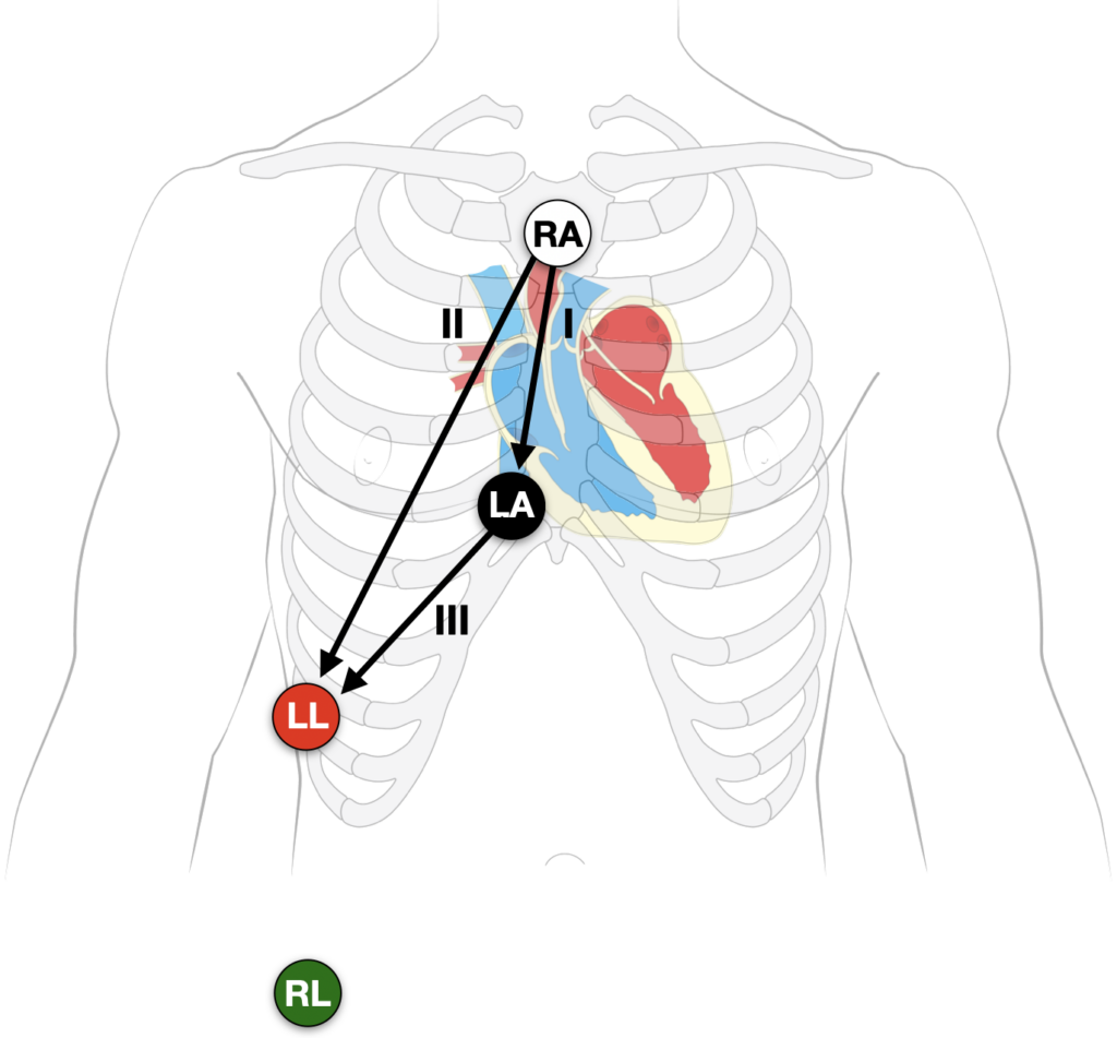 Lewis Lead electrode placement S5 lead with heart